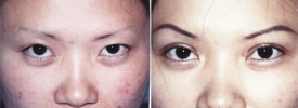 asian-blepharoplasty-p1