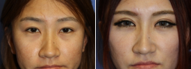 asian-blepharoplasty-p10-1