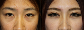 asian-blepharoplasty-p10-2