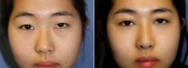 asian-blepharoplasty-p11-1