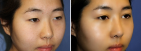 asian-blepharoplasty-p11-2
