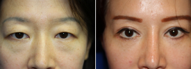 asian-blepharoplasty-p12