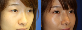 asian-blepharoplasty-p13-1