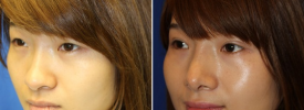 asian-blepharoplasty-p13-2