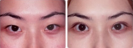 asian-blepharoplasty-p2