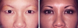 asian-blepharoplasty-p3