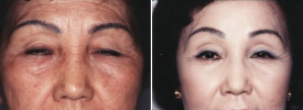 asian-blepharoplasty-p5