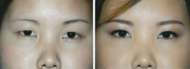 asian-blepharoplasty-p6