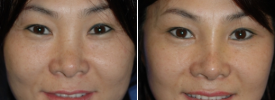 asian-blepharoplasty-p7