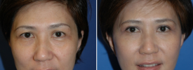asian-blepharoplasty-p8