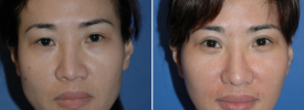 asian-blepharoplasty-p9-1