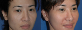 asian-blepharoplasty-p9-2