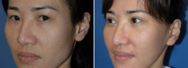 asian-blepharoplasty-p9-3