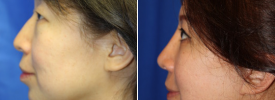 asian-rhinoplasty-p11-1