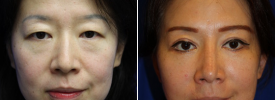 asian-rhinoplasty-p11-2