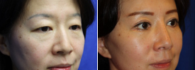 asian-rhinoplasty-p11-3