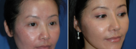 asian-rhinoplasty-p8-2