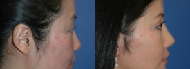 asian-rhinoplasty-p8-3