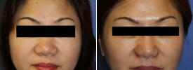asian-rhinoplasty-p9-1