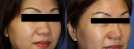 asian-rhinoplasty-p9-2