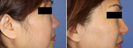 asian-rhinoplasty-p9-3