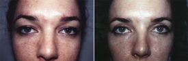 blepharoplasty-p1