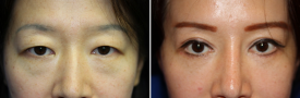 blepharoplasty-p10