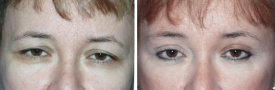 blepharoplasty-p2