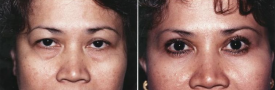 blepharoplasty-p3