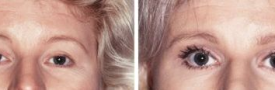 blepharoplasty-p4