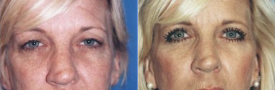 blepharoplasty-p5-1