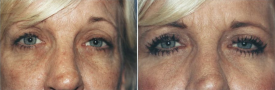 blepharoplasty-p5-2