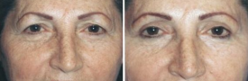 blepharoplasty-p6-1