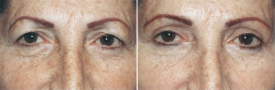blepharoplasty-p6-2