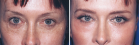 blepharoplasty-p7