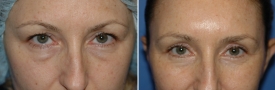 blepharoplasty-p8