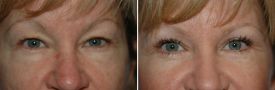 blepharoplasty-p9