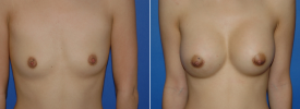 breast-augmentation-p1-1