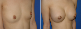 breast-augmentation-p1-2
