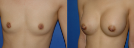 breast-augmentation-p1-3