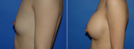 breast-augmentation-p1-5