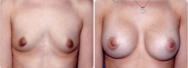 breast-augmentation-p10