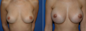 breast-augmentation-p11-1