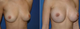 breast-augmentation-p11-2