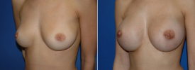 breast-augmentation-p11-3