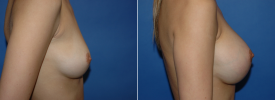 breast-augmentation-p11-4