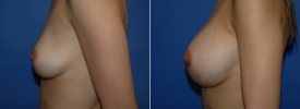 breast-augmentation-p11-5
