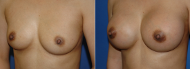 breast-augmentation-p17-2