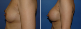 breast-augmentation-p17-3