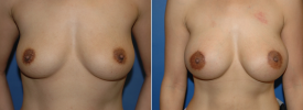 breast-augmentation-p18